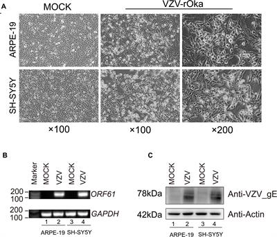 Transcriptome Analysis Reveals the Role of Cellular Calcium Disorder in Varicella Zoster Virus-Induced Post-Herpetic Neuralgia